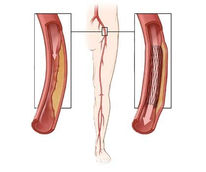 420x350-Peripheral-Angiogram