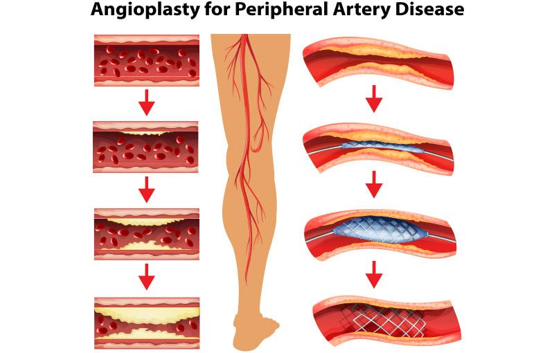 peripheral-angiography-and-angioplasty-2-1
