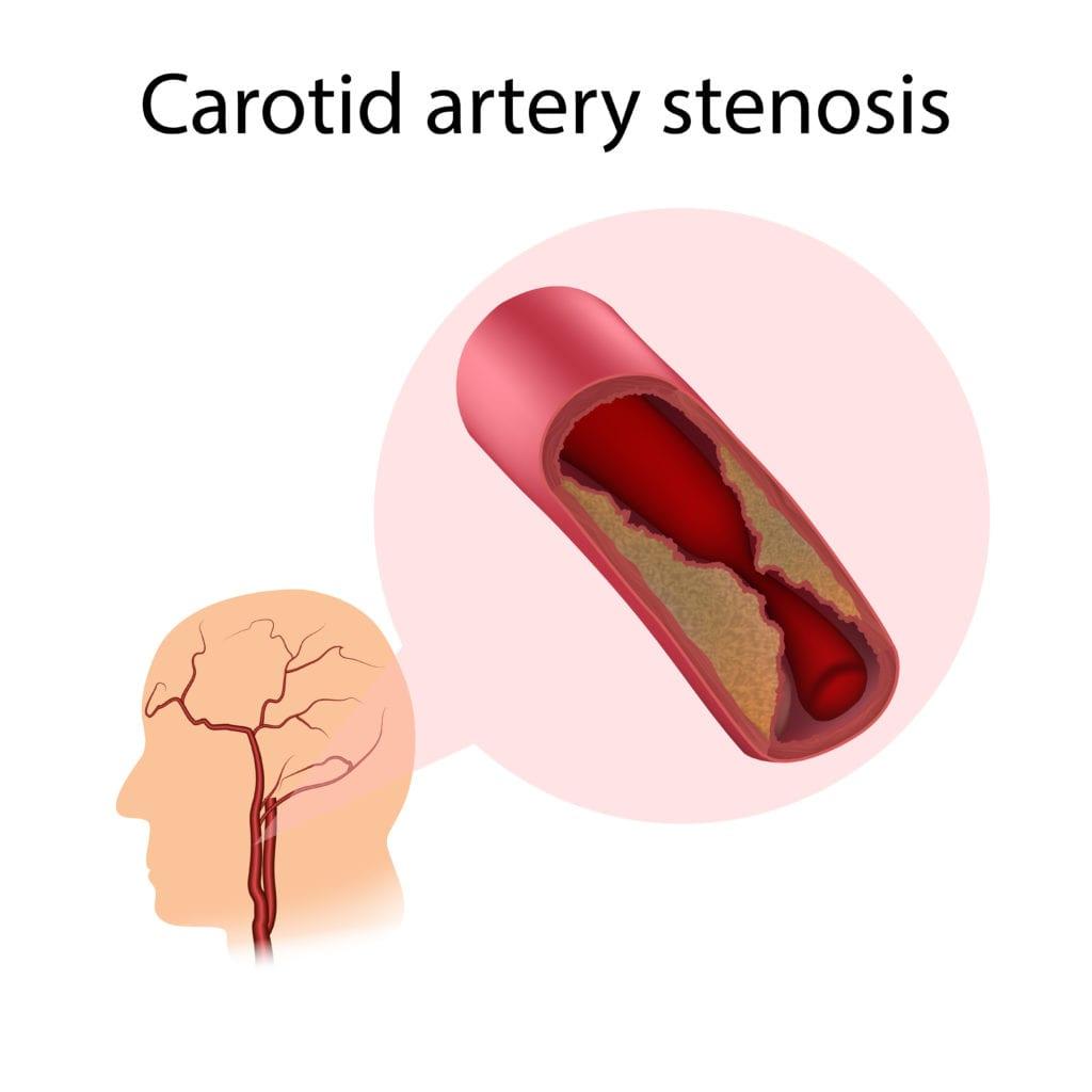 carotid-artery-stenosis-1024x1024
