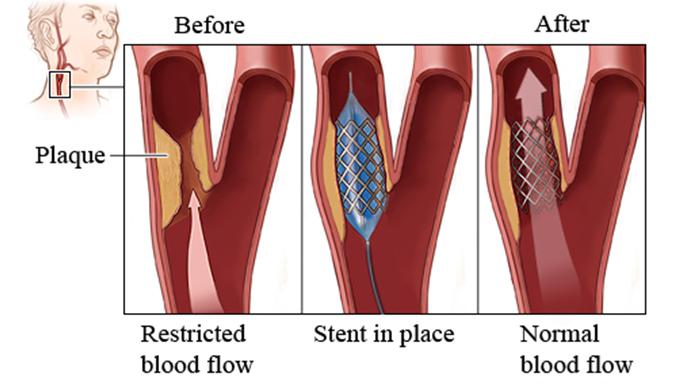 HPV-Carotid-Artery-Stenosis