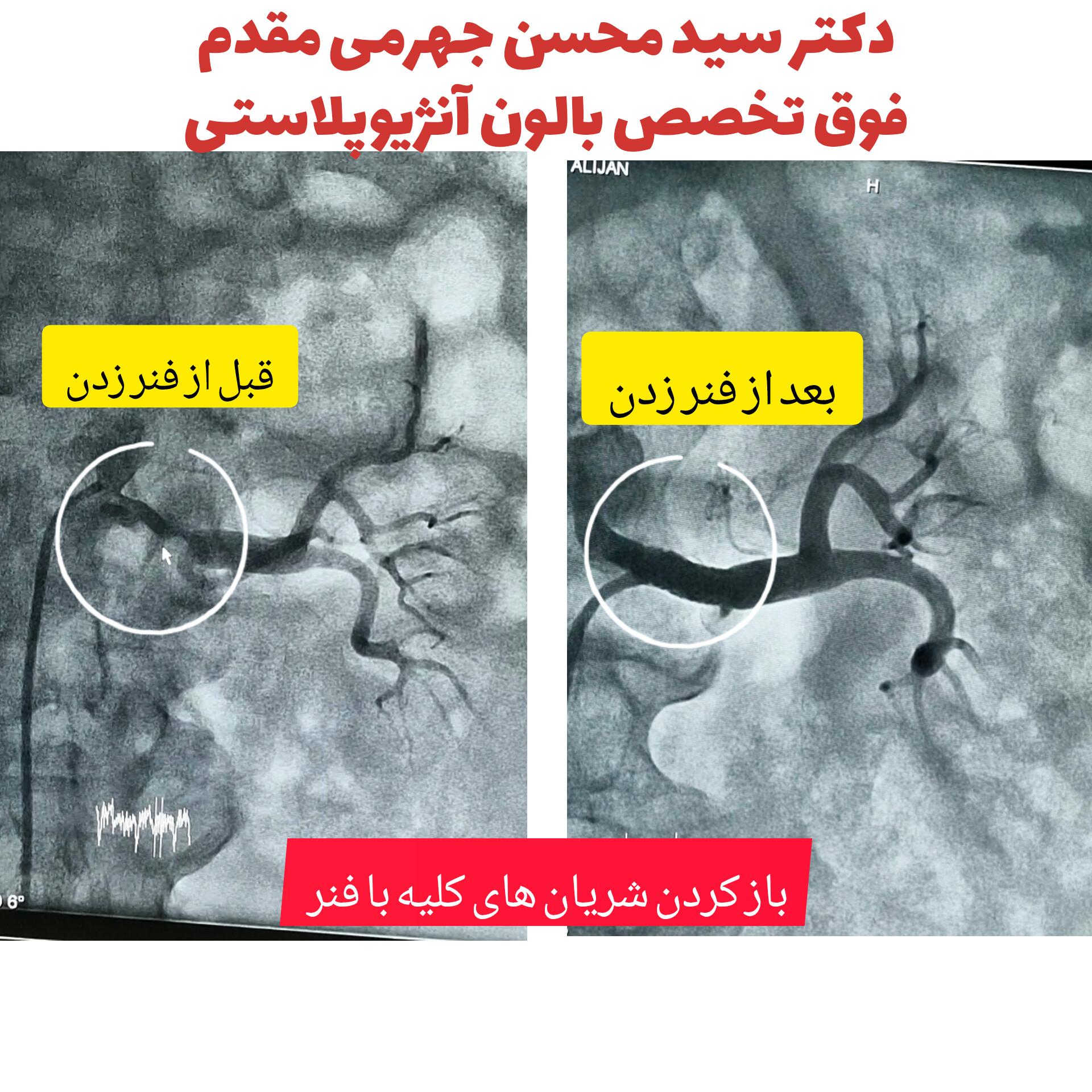 پلاستی کلیه