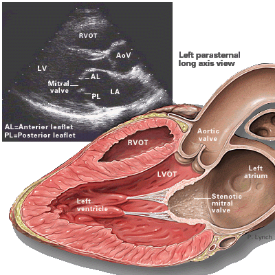 mitral_stenosis