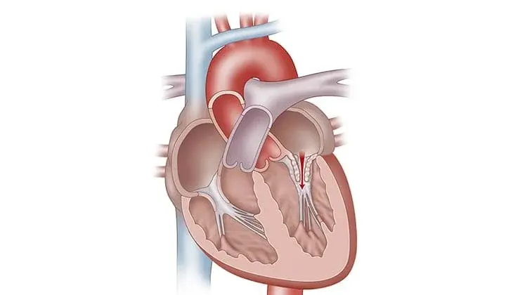 Mitral-Stenosis