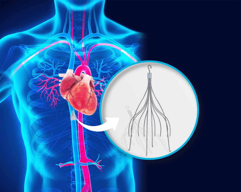 IVC-Filter-533696142-e1732122374564