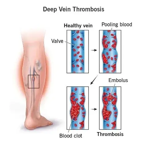 deep-vein-thrombosis-dvt