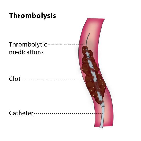 Treatment-13-Thrombolysis-thrombectomy-for-deep-vein-thrombosis-DVT1