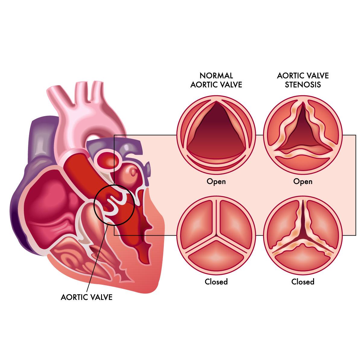 Aortic-valve-disease-1