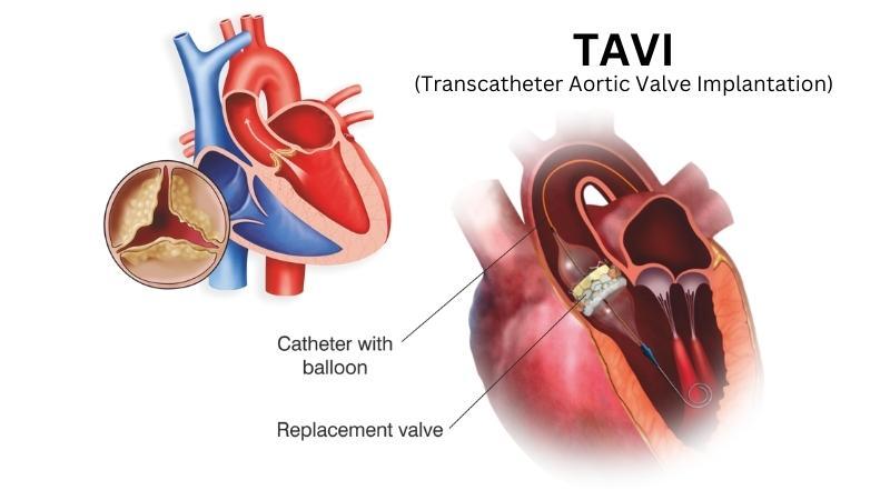 TAVI-Expert-in-India