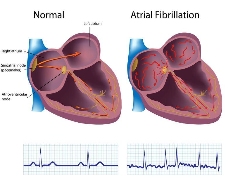 Atrial-fibrillation