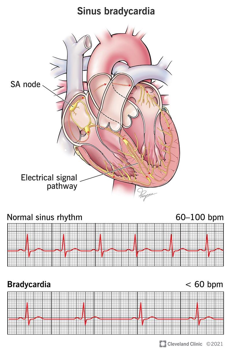 22473-sinus-bradycardia