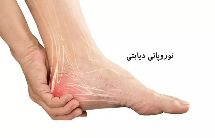 نوروپاتی-دیابتی-min
