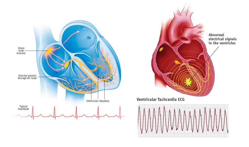 normal-heartbeat-vs-tachycardia-VT