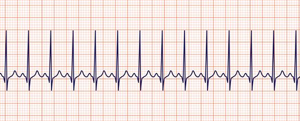 تاکی-کاردی-سینوسی-