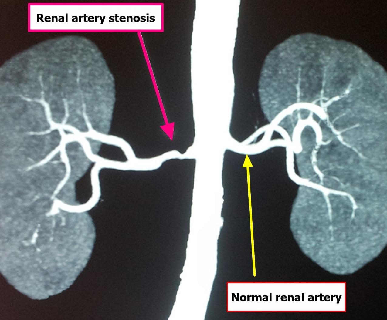 renal-artery-stenosis (1)