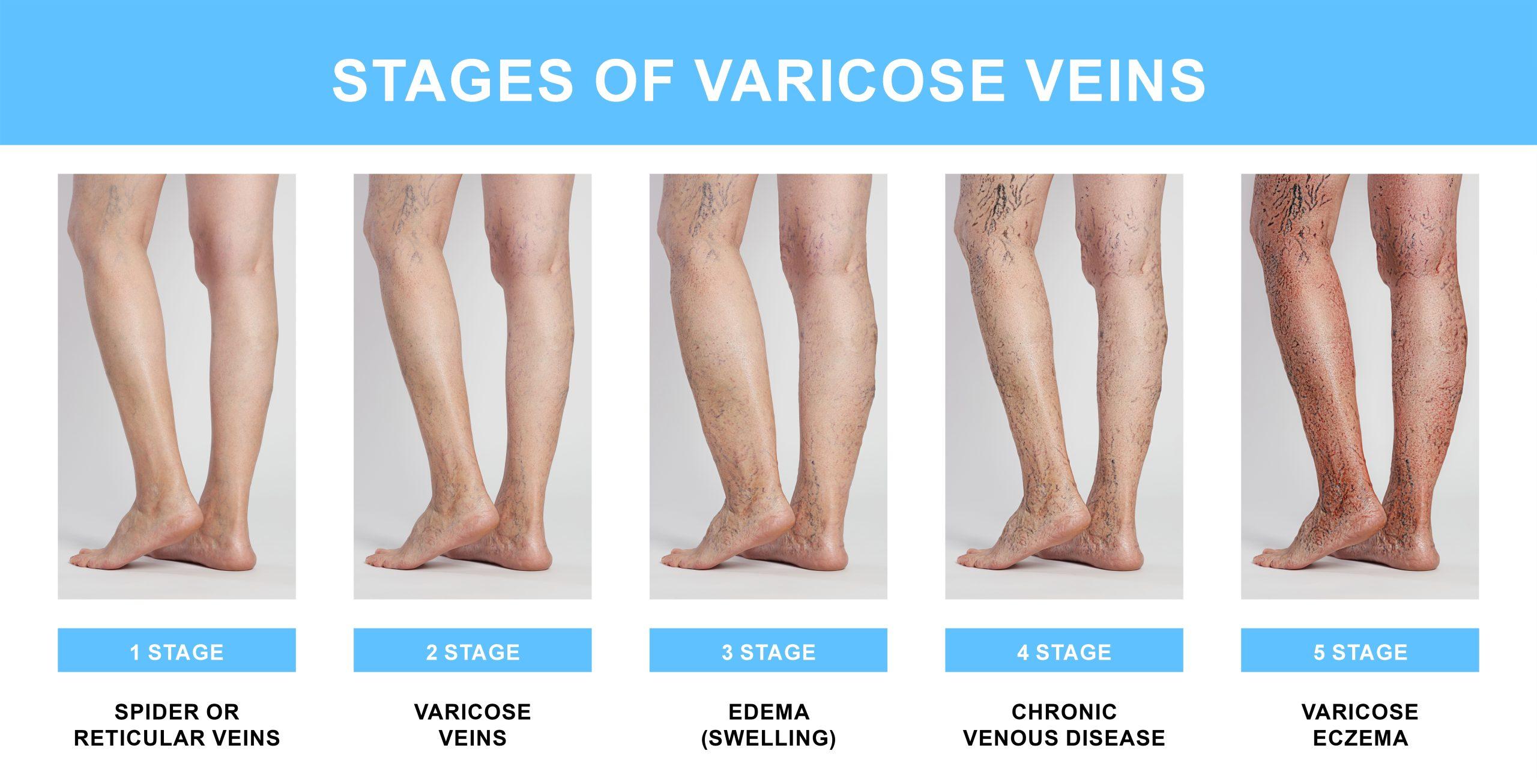 varicose-vein-stages-scaled