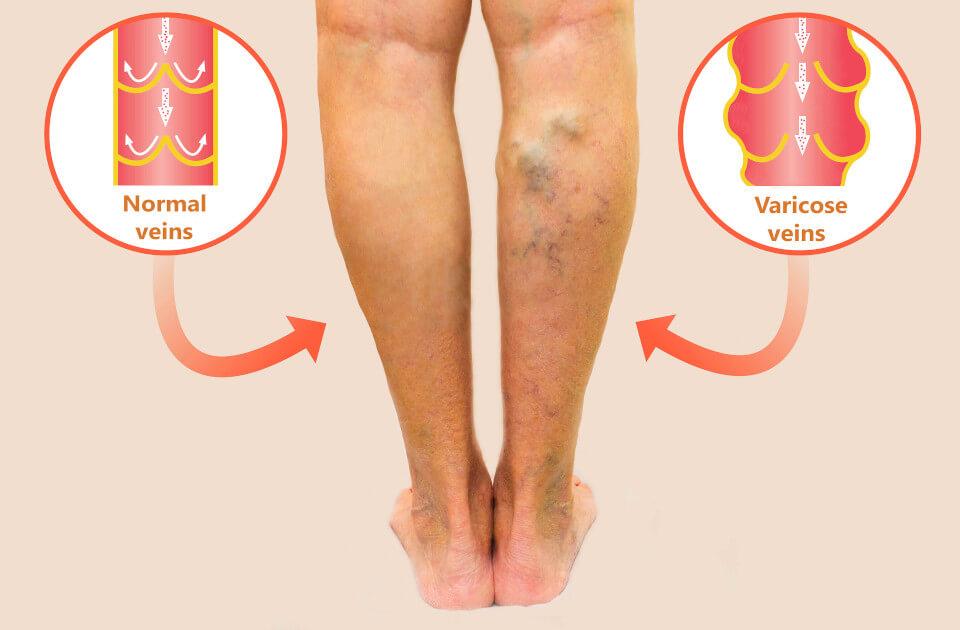 varicose-veins