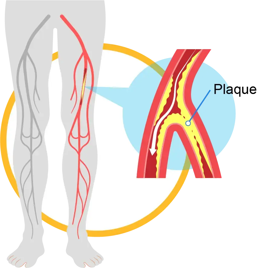 آنژیوگرافی عروق اندام های تحتانی