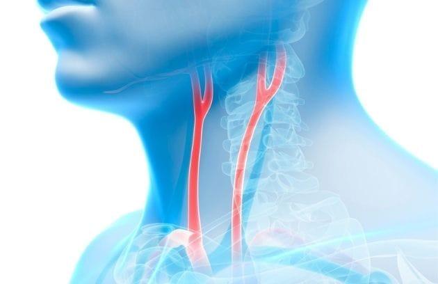درمان تنگی شریان گردن(کاروتید)
