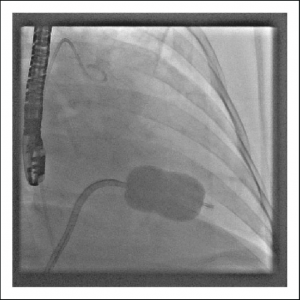 درمان تنگی دریچه میترال توسط بالون(PTMC)