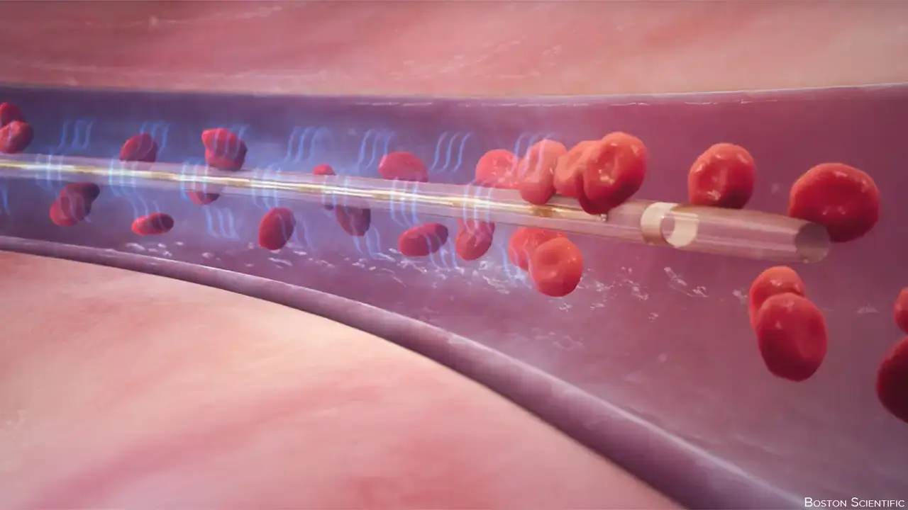 درمان لخته خون توسط کتتر مک نامارا (CDT)