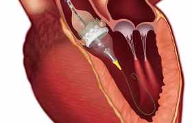 مشکلات دریچه آئورت و راه‌های درمان نوین