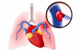 آمبولی ریه (Pulmonary Embolism)
