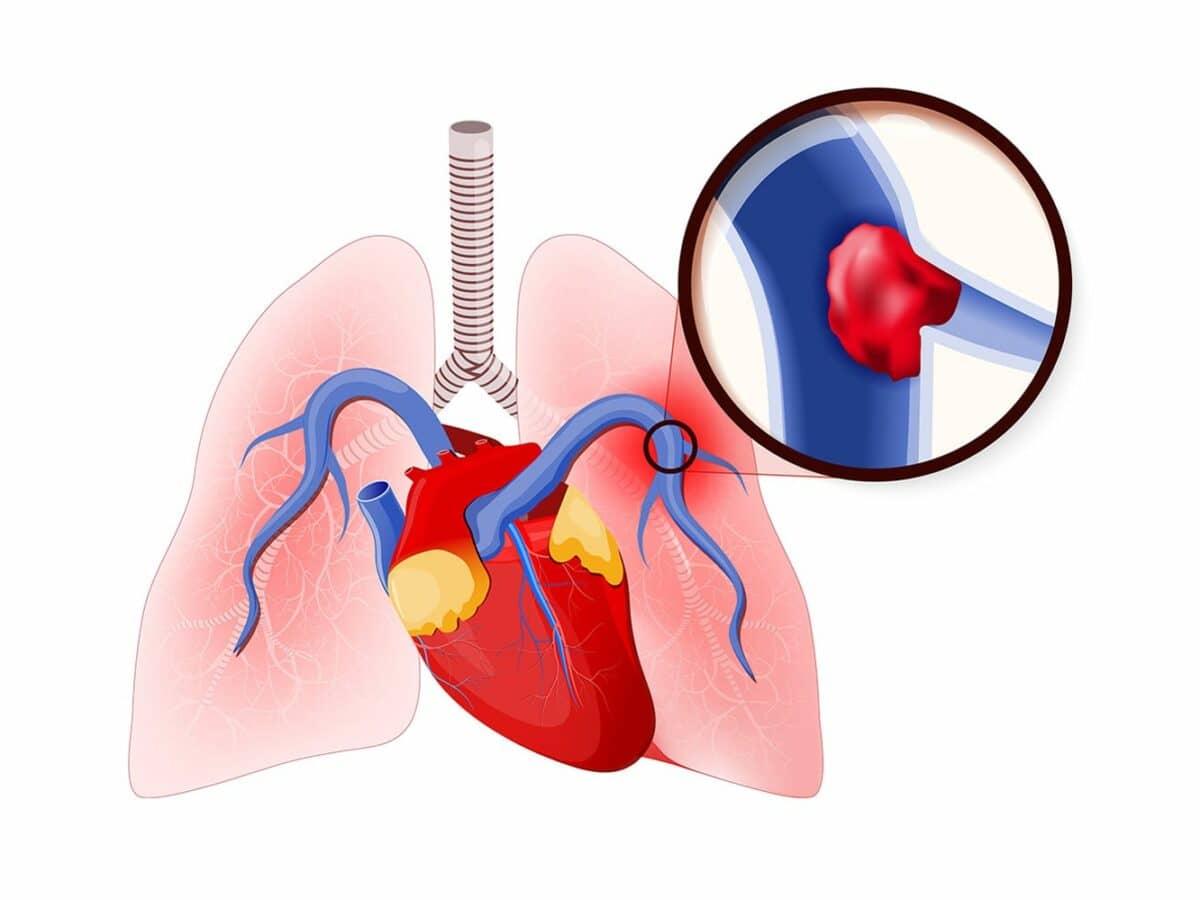 آمبولی ریه (Pulmonary Embolism)