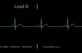 برادی آریتمی‌ های قلبی