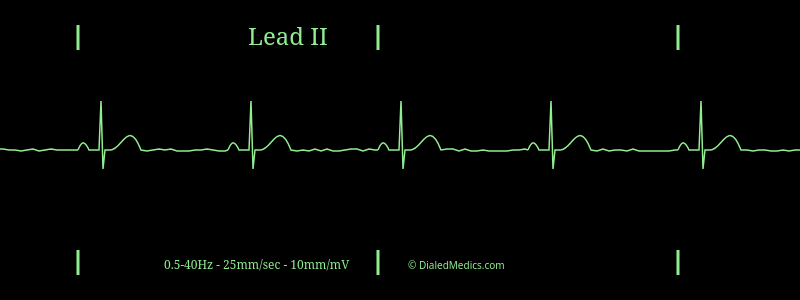 برادی آریتمی‌ های قلبی