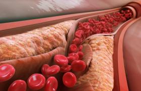 چربی خون بالا چیست؟