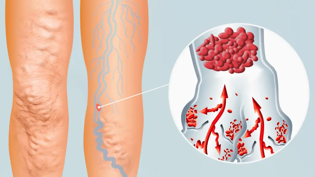 ترومبوز ورید عمقی (DVT)