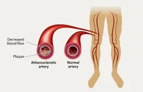 بیماری شریان محیطی (PAD) چیست؟