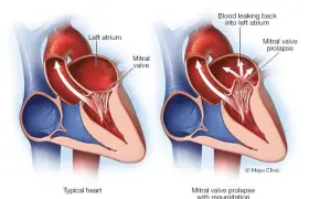 پرولاپس یا افتادگی دریچه میترال (MVP)