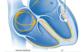 تاکی‌ آریتمی‌ های قلبی