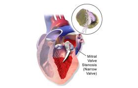 تنگی دریچه میترال