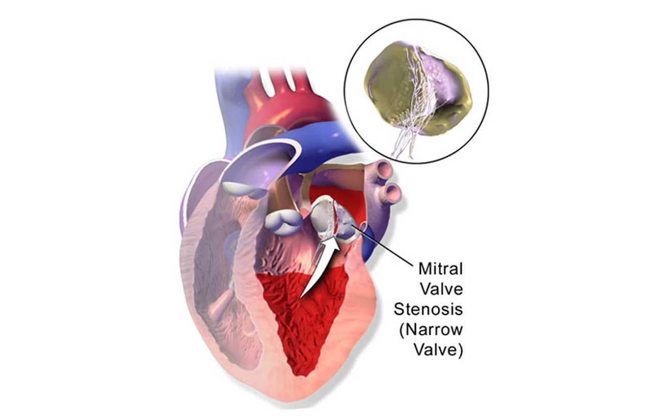 تنگی دریچه میترال