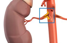 تنگی شریان کلیه