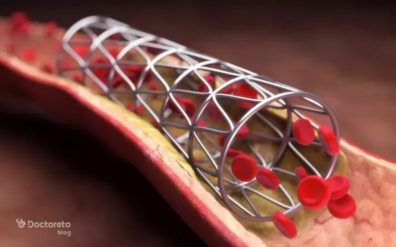 مراقبت‌های بعد از آنژیوگرافی قلب