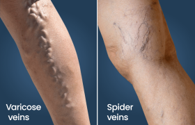 واریس چیست؟