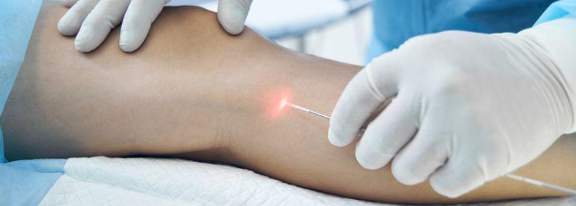 لیزر داخل عروقی واریس (EVLA)